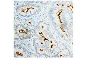Immunohistochemistry (IHC) image for anti-Carcinoembryonic Antigen-Related Cell Adhesion Molecule 5 (CEACAM5) antibody (ABIN1106531) (CEACAM5 anticorps)