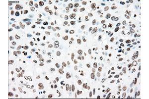 Immunohistochemical staining of paraffin-embedded Adenocarcinoma of colon tissue using anti-PLK1mouse monoclonal antibody. (PLK1 anticorps)