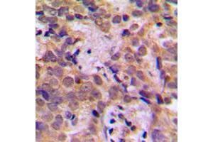 Immunohistochemical analysis of NF-kappaB p105 (pS932) staining in human breast cancer formalin fixed paraffin embedded tissue section.