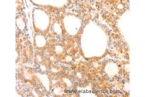 Immunohistochemistry of Human thyroid cancer using NAP1L1 Polyclonal Antibody at dilution of 1:70
