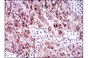 Immunohistochemical analysis of paraffin-embedded liver cancer tissues using FLT3 mouse mAb with DAB staining.