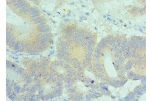 Immunohistochemistry of paraffin-embedded human colon cancer using ABIN7169161 at dilution of 1:100 (PLK2 anticorps  (AA 336-685))