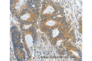 Immunohistochemistry of Human colon cancer using ASPA Polyclonal Antibody at dilution of 1:60 (ASPA anticorps)