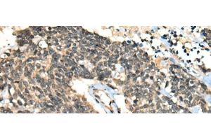 Immunohistochemistry of paraffin-embedded Human lung cancer tissue using CCNB1IP1 Polyclonal Antibody at dilution of 1:30(x200)