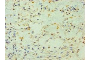 Immunohistochemistry of paraffin-embedded human breast cancer using ABIN7163201 at dilution of 1:100