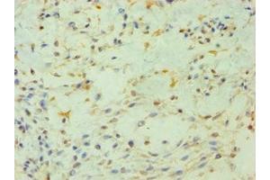Immunohistochemistry of paraffin-embedded human breast cancer using ABIN7163201 at dilution of 1:100 (PIP4K2B anticorps  (AA 1-270))