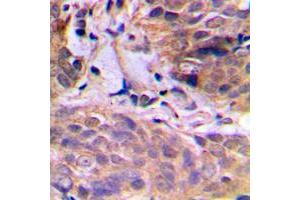 Immunohistochemical analysis of HuB staining in human breast cancer formalin fixed paraffin embedded tissue section. (HuB (Center) anticorps)