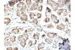Formalin-fixed, paraffin-embedded human Breast Carcinoma stained with NME2 / nm23-H2 Mouse Monoclonal Antibody (CPTC-NME2-2). (NME2 anticorps)
