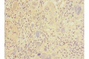 Immunohistochemistry of paraffin-embedded human liver cancer using ABIN7146045 at dilution of 1:100 (C-Type Lectin Domain Family 1, Member B (CLEC1B) (AA 55-229) anticorps)