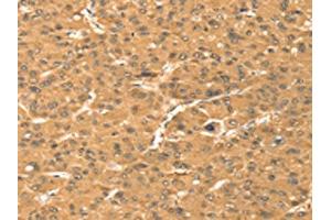 The image on the left is immunohistochemistry of paraffin-embedded Human liver cancer tissue using ABIN7131392(TMEM123 Antibody) at dilution 1/25, on the right is treated with fusion protein.