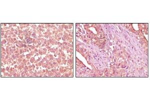 Immunohistochemical analysis of paraffin-embedded human skin carcinoma (left) and pancreas carcinoma (right) tissue, showing cytoplasmic localization using EphA2 mouse mAb with DAB staining. (EPH Receptor A2 anticorps)