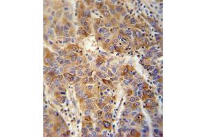 VP4 antibody (Center) (ABIN652042 and ABIN2840516) immunohistochemistry analysis in formalin fixed and paraffin embedded human hepatocarcinoma followed by peroxidase conjugation of the secondary antibody and DAB staining.