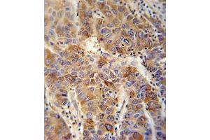 VP4 antibody (Center) (ABIN652042 and ABIN2840516) immunohistochemistry analysis in formalin fixed and paraffin embedded human hepatocarcinoma followed by peroxidase conjugation of the secondary antibody and DAB staining. (VAMP4 anticorps  (AA 16-45))