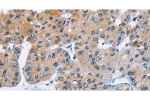 Immunohistochemistry of paraffin-embedded Human liver cancer using ATXN1 Polyclonal Antibody at dilution of 1:40 (Ataxin 1 anticorps)