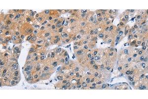 Immunohistochemistry of paraffin-embedded Human liver cancer using ATXN1 Polyclonal Antibody at dilution of 1:40 (Ataxin 1 anticorps)