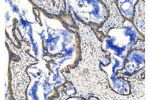 ABIN6260218 and ABIN6276684 at 1/100 staining Human colorectal cancer by IHC-P.