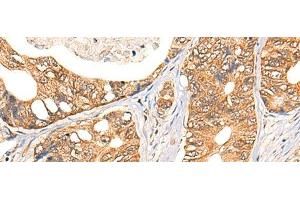 Immunohistochemistry of paraffin-embedded Human gastric cancer tissue using NOL8 Polyclonal Antibody at dilution of 1:40(x200) (NOL8 anticorps)