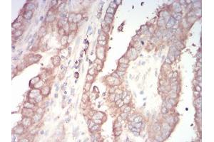 Immunohistochemical analysis of paraffin-embedded TFAP2A tissues using endometrial cancer mouse mAb with DAB staining.