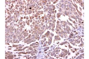 IHC-P Image CCKBR antibody [C1C2], Internal detects CCKBR protein at cytosol on human lung carcinoma by immunohistochemical analysis. (CCKBR anticorps  (C-Term))