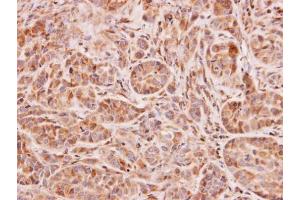 IHC-P Image Immunohistochemical analysis of paraffin-embedded A549 xenograft, using NAT2, antibody at 1:100 dilution.