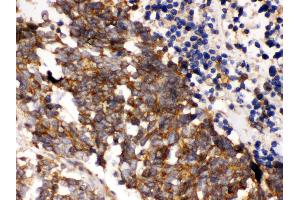 Anti- PLK1 Picoband antibody,IHC(P) IHC(P): Human Lung Cancer Tissue