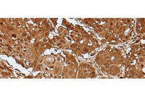 Immunohistochemistry of paraffin-embedded Human esophagus cancer tissue using UBA7 Polyclonal Antibody at dilution of 1:35(x200)