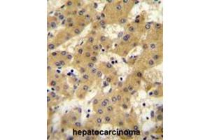 APOF antibody (Center) immunohistochemistry analysis in formalin fixed and paraffin embedded human hepatocarcinoma followed by peroxidase conjugation of the secondary antibody and DAB staining. (Apolipoprotein F anticorps  (Middle Region))