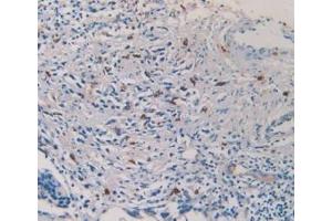 Detection of TPS in Human Prostate Gland Cancer Tissue using Monoclonal Antibody to Tryptase (TPS)