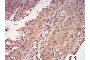 0:Immunohistochemical analysis of paraffin-embedded endometrial cancer tissues using YWHAB mouse mAb with DAB staining.