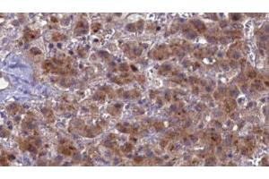 ABIN6276852 at 1/100 staining Human liver cancer tissue by IHC-P. (PTH1R anticorps  (pThr1))