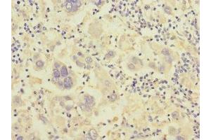 Immunohistochemistry of paraffin-embedded human liver cancer using ABIN7156498 at dilution of 1:100 (Integrin beta 7 anticorps  (AA 1-140))