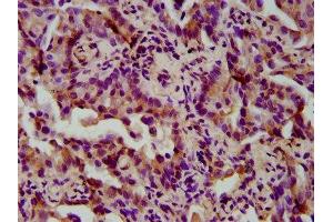 IHC image of ABIN7166187 diluted at 1:300 and staining in paraffin-embedded human lung cancer performed on a Leica BondTM system. (TIMELESS anticorps  (AA 1004-1131))