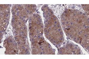 ABIN6272757 at 1/100 staining Human liver cancer tissue by IHC-P. (OR13C5 anticorps  (C-Term))