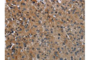The image on the left is immunohistochemistry of paraffin-embedded Human liver cancer tissue using ABIN7129423(FAAH Antibody) at dilution 1/50, on the right is treated with fusion protein. (FAAH anticorps)