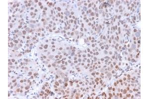 Formalin-fixed, paraffin-embedded human Colon Carcinoma stained with RNA Polymerase II / Poll II Mouse Monoclonal Antibody (8A7).