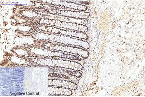 Immunohistochemical analysis of paraffin-embedded human colon cancer tissue. (EIF4A1 anticorps)