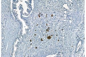 ABIN6259984 and ABIN6272242 at 1/100 staining Human pancreatic cancer by IHC-P.