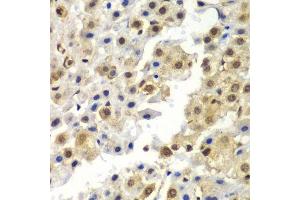 Immunohistochemistry of paraffin-embedded human liver cancer using SYNCRIP antibody.