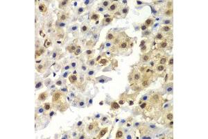 Immunohistochemistry of paraffin-embedded human liver cancer using SYNCRIP antibody. (SYNCRIP anticorps  (AA 1-200))