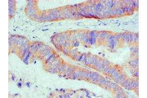 Immunohistochemical of paraffin-embedded Human Colon cancer tissue using ABIN7145293 at dilution of 1:200