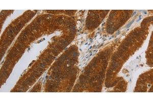 Immunohistochemistry of paraffin-embedded Human colon cancer using NIT2 Polyclonal Antibody at dilution of 1:40 (NIT2 anticorps)