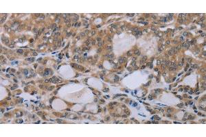 Immunohistochemistry of paraffin-embedded Human thyroid cancer tissue using NAIP Polyclonal Antibody at dilution 1:30 (NAIP anticorps)