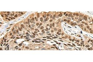 Immunohistochemistry of paraffin-embedded Human esophagus cancer tissue using CCDC112 Polyclonal Antibody at dilution of 1:45(x200) (CCDC112 anticorps)