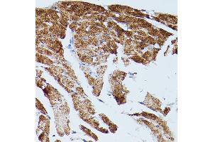 Immunohistochemistry of paraffin-embedded human colon carcinoma using SERC/ Rabbit pAb (ABIN3021429, ABIN3021430, ABIN3021431 and ABIN6215028) at dilution of 1:150 (40x lens).