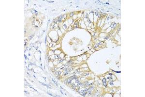 Immunohistochemistry of paraffin-embedded human colon carcinoma using GNAI3 antibody at dilution of 1:100 (40x lens). (GNAI3 anticorps)