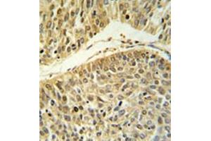 Formalin fixed paraffin embedded lung carcinoma stained with RERE Antibody (N-term) followed by peroxidase conjugation of the secondary antibody and DAB staining. (RERE anticorps  (N-Term))