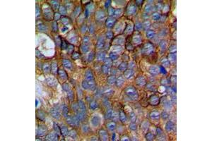 Immunohistochemical analysis of NCALD staining in human prostate cancer formalin fixed paraffin embedded tissue section.