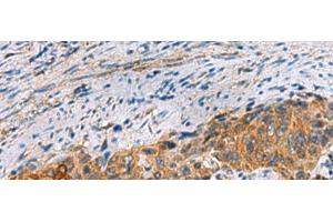 Immunohistochemistry of paraffin-embedded Human cervical cancer tissue using JOSD1 Polyclonal Antibody at dilution of 1:70(x200) (JOSD1 anticorps)