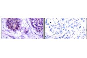 Immunohistochemical analysis of paraffin-embedded human breast carcinoma tissue using BCL-XL (phospho-Ser62) antibody (E011066). (BCL2L1 anticorps  (pSer62))