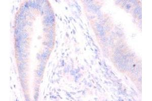 Immunohistochemistry of paraffin-embedded human colon cancer using ABIN7171243 at dilution of 1:100 (Syntaxin 6 anticorps  (AA 5-234))